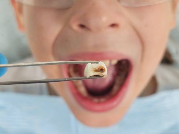 Best Knocked-Out Tooth (Avulsed Tooth) Treatment in South Milwaukee, WI